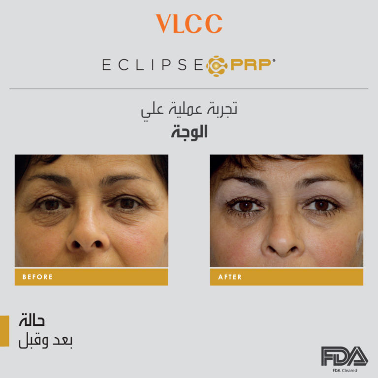 ECLIPSE PRP_Before & after-02